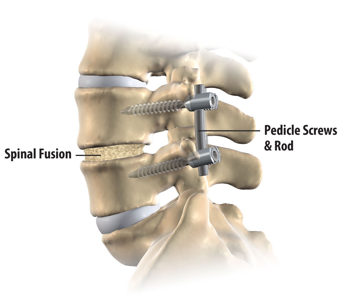 Non-Fusion Spinal Devices Market Non-Fusion Spinal Devices Market